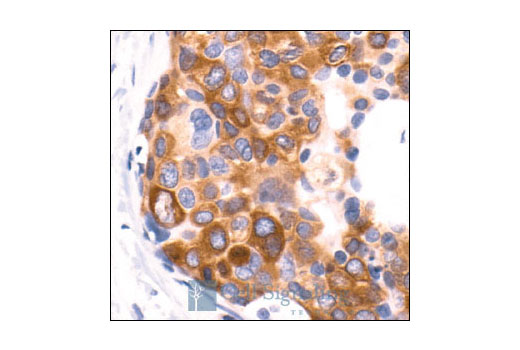 Immunohistochemical analysis of paraffin-embedded human breast carcinoma, showing cytoplasmic localization, using Phospho-Acetyl-CoA Carboxylase (Ser79) Antibody.