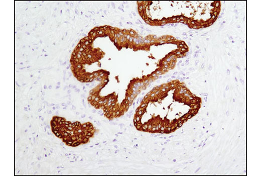 Immunohistochemical analysis of human prostate carcinoma using Prostatic Acid Phosphatase (D3Y5P) Rabbit mAb.