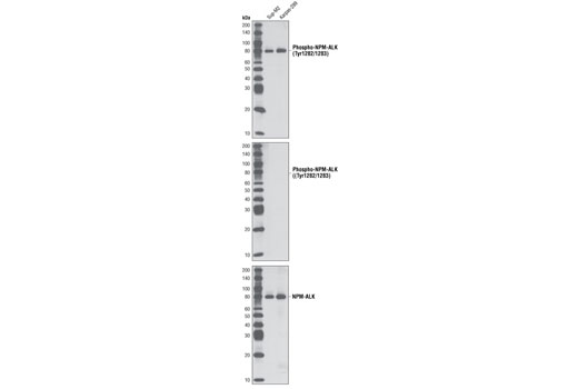 Western blot analysis of extracts from Sup-M2 and Karpas-299 cells using Phospho-ALK (Tyr1282/1283) Antibody (upper and middle) and ALK (C26G7) Rabbit mAb #3333 (lower). The middle and lower blots were treated with calf intestinal phosphatase to dephosphorylate NPM-ALK. Cell Line Source: Dr Abraham Karpas at the University of Cambridge.