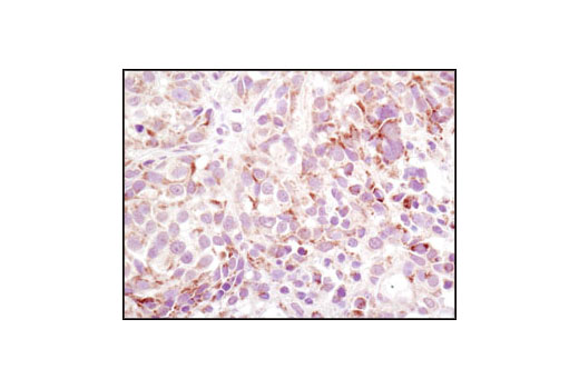 Immunohistochemical analysis of paraffin-embedded human melanoma using β-Arrestin 2 (C16D9) Rabbit mAb.