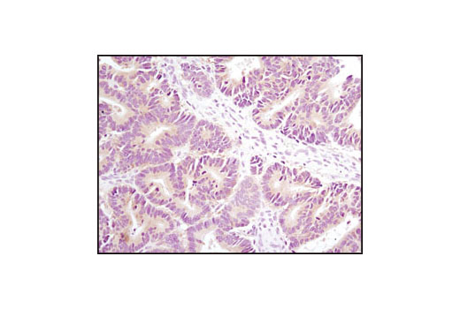 Immunohistochemical analysis of paraffin-embedded human colon carcinoma using Axin1 (C76H11) Rabbit mAb.