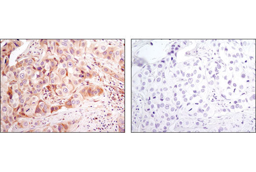 Immunohistochemical analysis of paraffin-embedded human breast caricnoma using Bax (D2E11) Rabbit mAb in the presence of control peptide (upper) or antigen-specific peptide (lower).