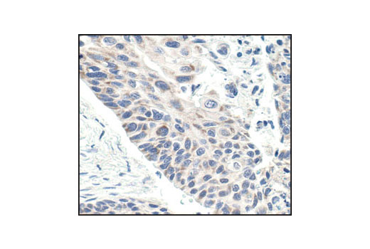 Immunohistochemical analysis of paraffin-embedded human lung carcinoma using Bax Antibody.