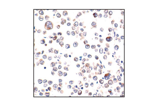 Immunohistochemical analysis of paraffin-embedded human Non-Hodgkin's lymphoma using Bax Antibody.