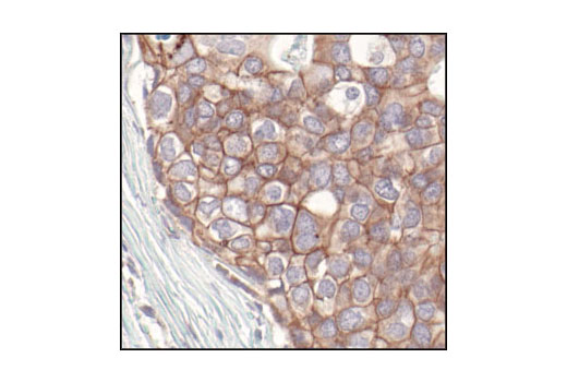 Immunohistochemical analysis of paraffin-embedded human breast carcinoma, using Pan-cadherin Antibody.