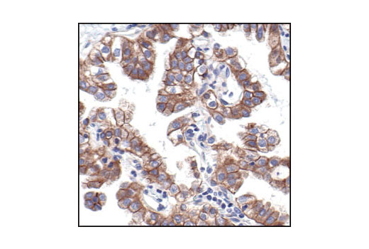 Immunohistochemical analysis of paraffin-embedded human bronchioalveolar cell carcinoma using Pan-cadherin Antibody, showing membrane localization.