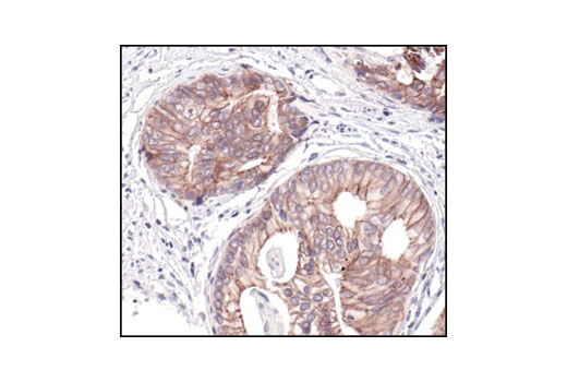 Immunohistochemical analysis of paraffin-embedded human prostate carcinoma, using Pan-cadherin Antibody.