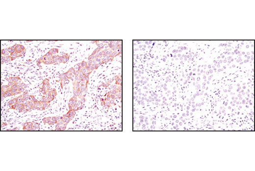 Immunohistochemical analysis of paraffin-embedded human breast carcinoma using Calnexin (C5C9) Rabbit mAb in the presence of control peptide (left) or antigen-specific peptide (right).