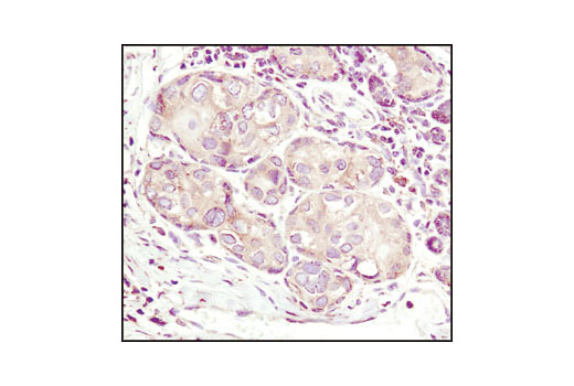 Immunohistochemical analysis of paraffin-embedded human lung carcinoma using Calnexin Antibody.