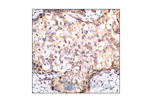 Immunohistochemical analysis of paraffin-embedded human breast carcinoma using beta-Catenin Antibody.