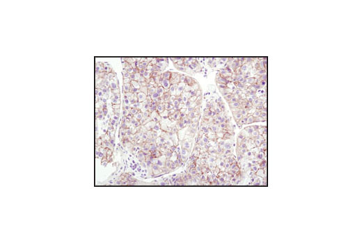 Immunohistochemical analysis of paraffin-embedded human hepatocellular carcinoma using β-Catenin (6B3) Rabbit mAb.