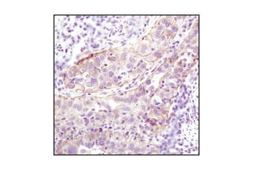 Immunohistochemical analysis of paraffin-embedded human lung carcinoma using β-Catenin (6B3) Rabbit mAb.