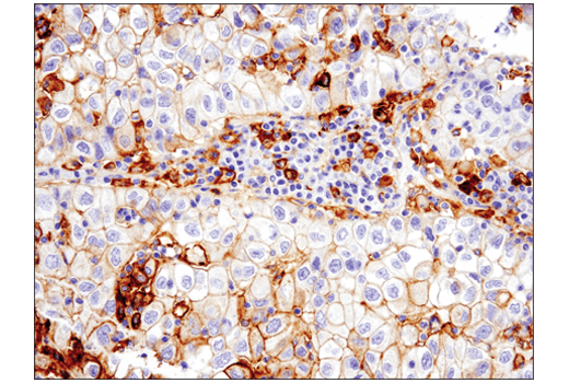 Immunohistochemical analysis of paraffin-embedded human non-small cell lung carcinoma using PD-L1 (E1L3N ® ) XP ® Rabbit mAb performed on the Leica® Bond™ Rx.