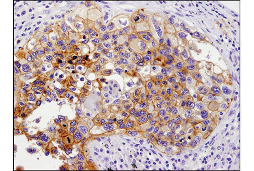 Immunohistochemical analysis of paraffin-embedded human lung carcinoma using PD-L1 (E1L3N ® ) XP ® Rabbit mAb.