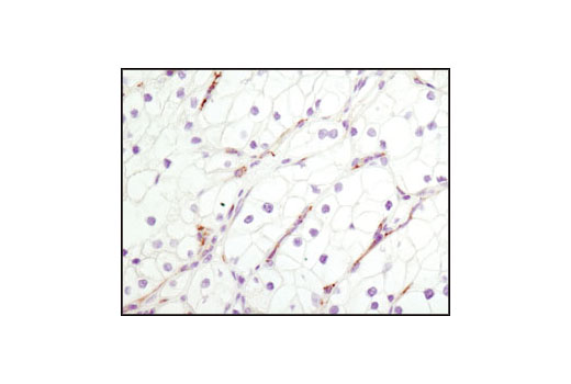 Immunohistochemical analysis of paraffin-embedded human clear cell carcinoma using CD31 (PECAM-1) (89C2) Mouse mAb.