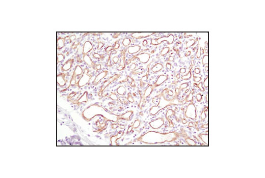 Immunohistochemical analysis of paraffin-embedded human capillary hemangioma using CD31 (PECAM-1) (89C2) Mouse mAb.