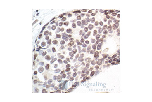 Immunohistochemical analysis of paraffin-embedded human breast carcinoma, showing nuclear localization, using CDK7 (MO1) Mouse mAb.