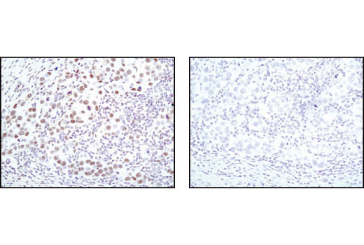 Immunohistochemical analysis of paraffin-embedded human breast carcinoma using CDK9 (C12F7) Rabbit mAb in the presence of control peptide (left) or antigen specific peptide (right).