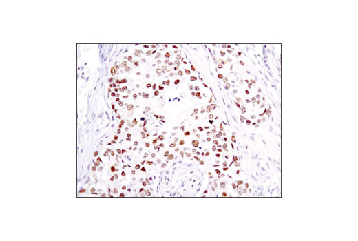 Immunohistochemical analysis of paraffin-embedded human breast carcinoma using Chk2 (1C12) Mouse mAb.