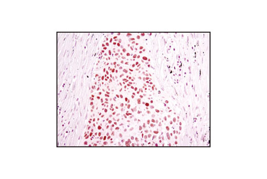 Immunohistochemical analysis of paraffin-embedded human lung carcinoma using Chk2 (1C12) Mouse mAb.