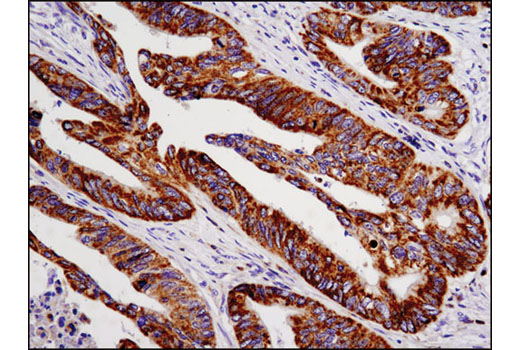 Immunohistochemical analysis of paraffin-embedded human colon carcinoma using Cox2 (D5H5) XP ® Rabbit mAb.