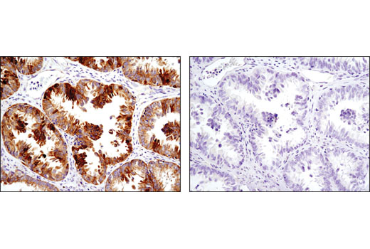 Immunohistochemical analysis of paraffin-embedded human ovarian carcinoma using Cox2 (D5H5) XP ® Rabbit mAb in the presence of control peptide (left) or antigen-specific peptide (right).