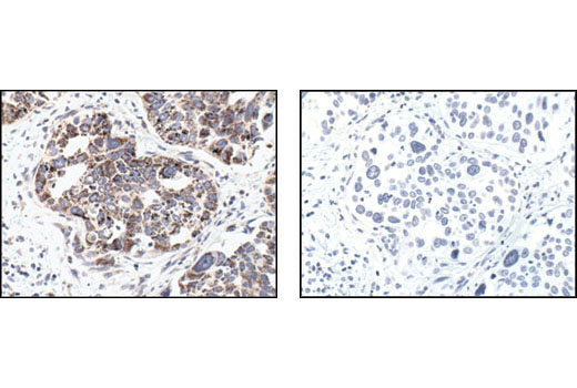 Immunohistochemical analysis of paraffin-embedded human lung carcinoma, using Cytochrome c (136F3) Rabbit mAb in the presence of control peptide (left) or Cytochrome c Blocking Peptide #1033 (right).