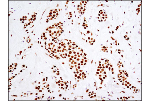 Immunohistochemical analysis of paraffin-embedded human breast carcinoma using DNA-PKcs (3H6) Mouse mAb.