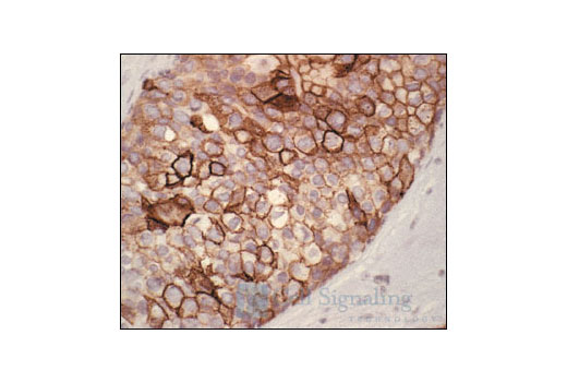 Immunohistochemical analysis of paraffin-embedded human breast tumor, showing membrane and cytoplasmic localization, using Phospho-EGF Receptor (Tyr1068) Antibody.