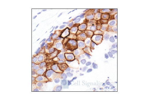 Immunohistochemical analysis of paraffin-embedded human breast carcinoma, showing membrane localization, using Phospho-EGF Receptor (Tyr992) Antibody.