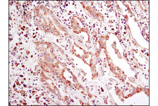 Immunohistochemical analysis of paraffin-embedded human lung carcinoma using eIF2α (D7D3) XP ® Rabbit mAb.