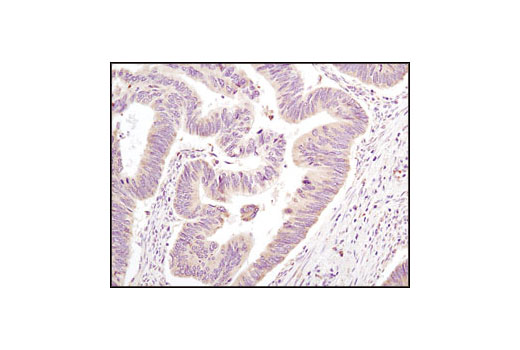 Immunohistochemical analysis of paraffin-embedded human colon carcinoma using eIF2α (L57A5) Mouse mAb.