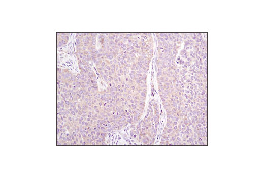 Immunohistochemical analysis of paraffin-embedded human lung carcinoma using eIF2α (L57A5) Mouse mAb.