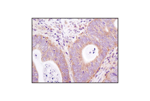 Immunohistochemical analysis of paraffin-embedded human colon carcinoma using eIF3A (D51F4) XP ® Rabbit mAb.