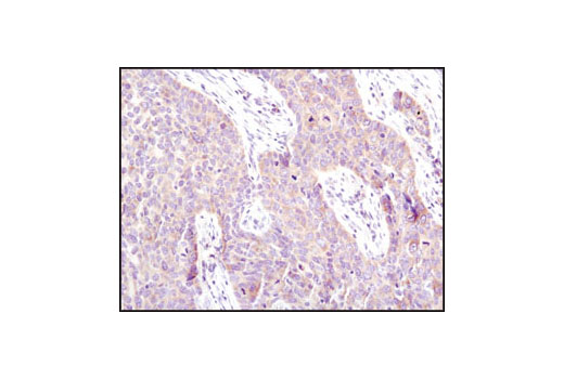 Immunohistochemical analysis of paraffin-embedded human lung carcinoma using eIF4G (C45A4) Rabbit mAb.