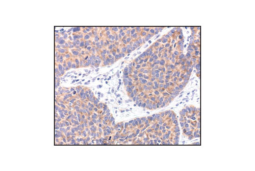 Immunohistochemical analysis of paraffin-embedded human lung carcinoma, showing cytoplasmic localization, using eIF4G Antibody.