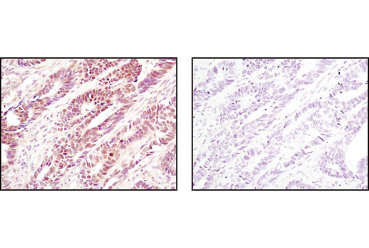 Immunohistochemical analysis of paraffin-embedded human colon carcinoma using eIF6 Antibody in the presence of control peptide (left) or antigen-specific peptide (right).