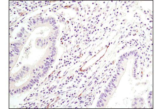 Immunohistochemical analysis of paraffin-embedded human colon adenocarcinoma using eNOS (6H2) Mouse mAb.
