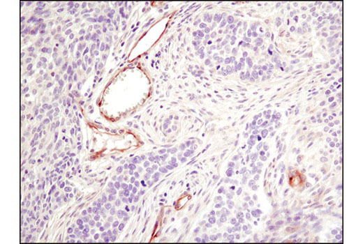 Immunohistochemical analysis of paraffin-embedded human lung adenocarcinoma using eNOS (6H2) Mouse mAb.