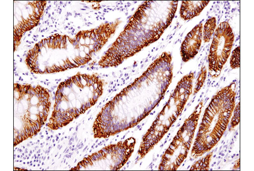 Immunohistochemical analysis of paraffin-embedded human colon carcinoma using EpCAM (D9S3P) Rabbit mAb (IHC Preferred).