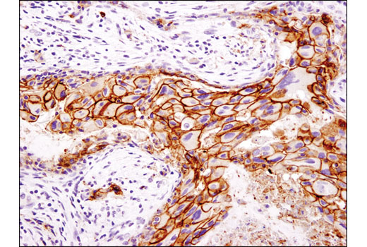 Immunohistochemical analysis of paraffin-embedded human infiltrating ductal breast carcinoma using EpCAM (D9S3P) Rabbit mAb (IHC Preferred).