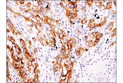 Immunohistochemical analysis of paraffin-embedded human non-small cell lung carcinoma using EpCAM (D9S3P) Rabbit mAb (IHC Preferred).