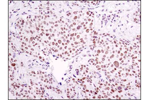Immunohistochemical analysis of paraffin-embedded human breast carcinoma using ERCC1 (D6G6) XP ® Rabbit mAb.