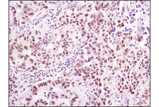 Immunohistochemical analysis of paraffin-embedded human lung carcinoma using ERCC1 (D6G6) XP ® Rabbit mAb.