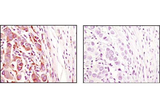 Immunohistochemical analysis of paraffin-embedded human breast carcinoma using ERp44 (D17A6) XP ® Rabbit mAb in the presence of control peptide (left) or antigen-specific peptide (right).