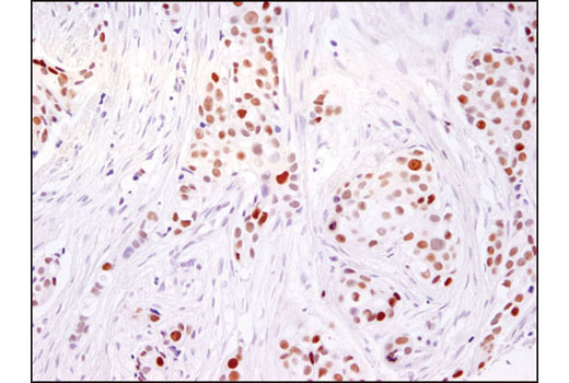 Immunohistochemical analysis of paraffin-embedded human breast carcinoma using Ezh2 (D2C9) XP ® Rabbit mAb.
