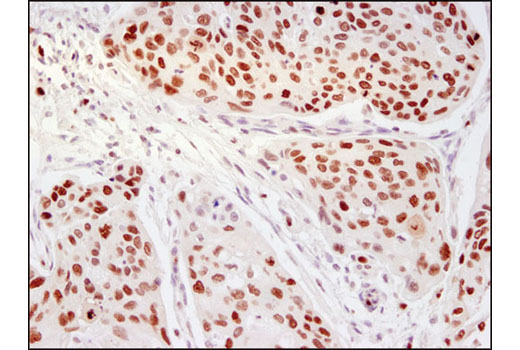 Immunohistochemical analysis of paraffin-embedded human cervical carcinoma using Ezh2 (D2C9) XP ® Rabbit mAb.