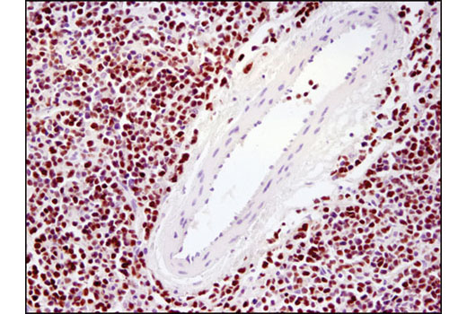 Immunohistochemical analysis of paraffin-embedded human lymphoma using Ezh2 (D2C9) XP ® Rabbit mAb.