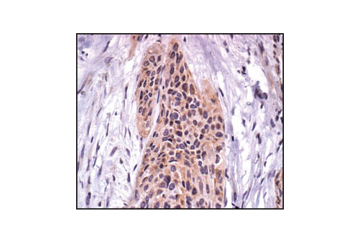 Immunohistochemical analysis of paraffin-embedded human breast carcinoma, using FAK Antibody.