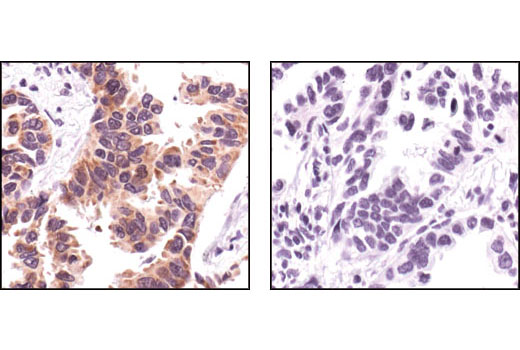 Immunohistochemical analysis of paraffin-embedded human lung carcinoma, using FAK Antibody in thre presence of control peptide (left) or antigen-specific peptide (right).